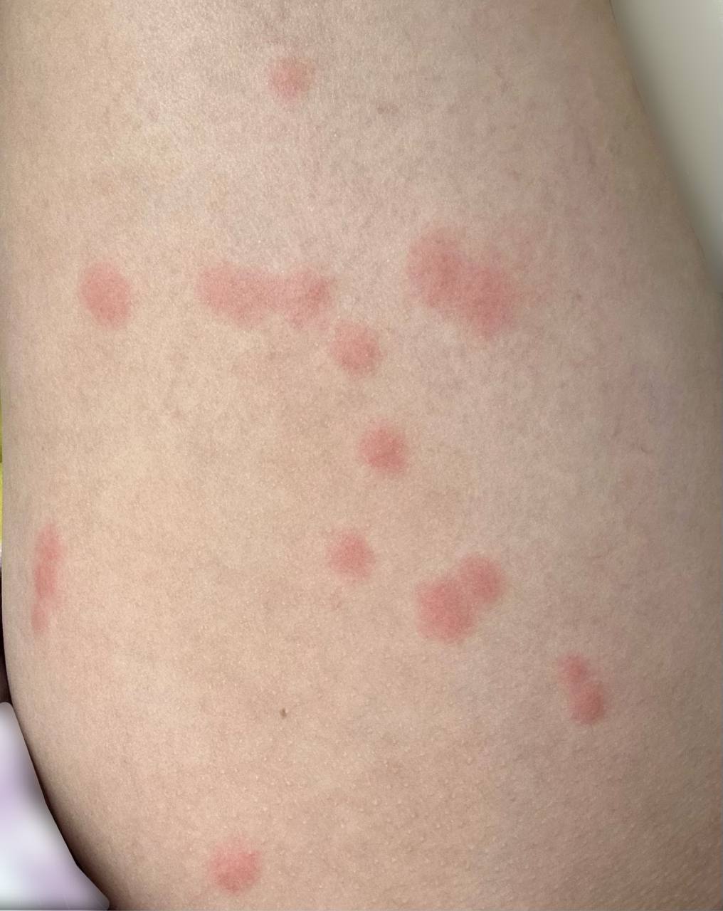 scoot insect bites