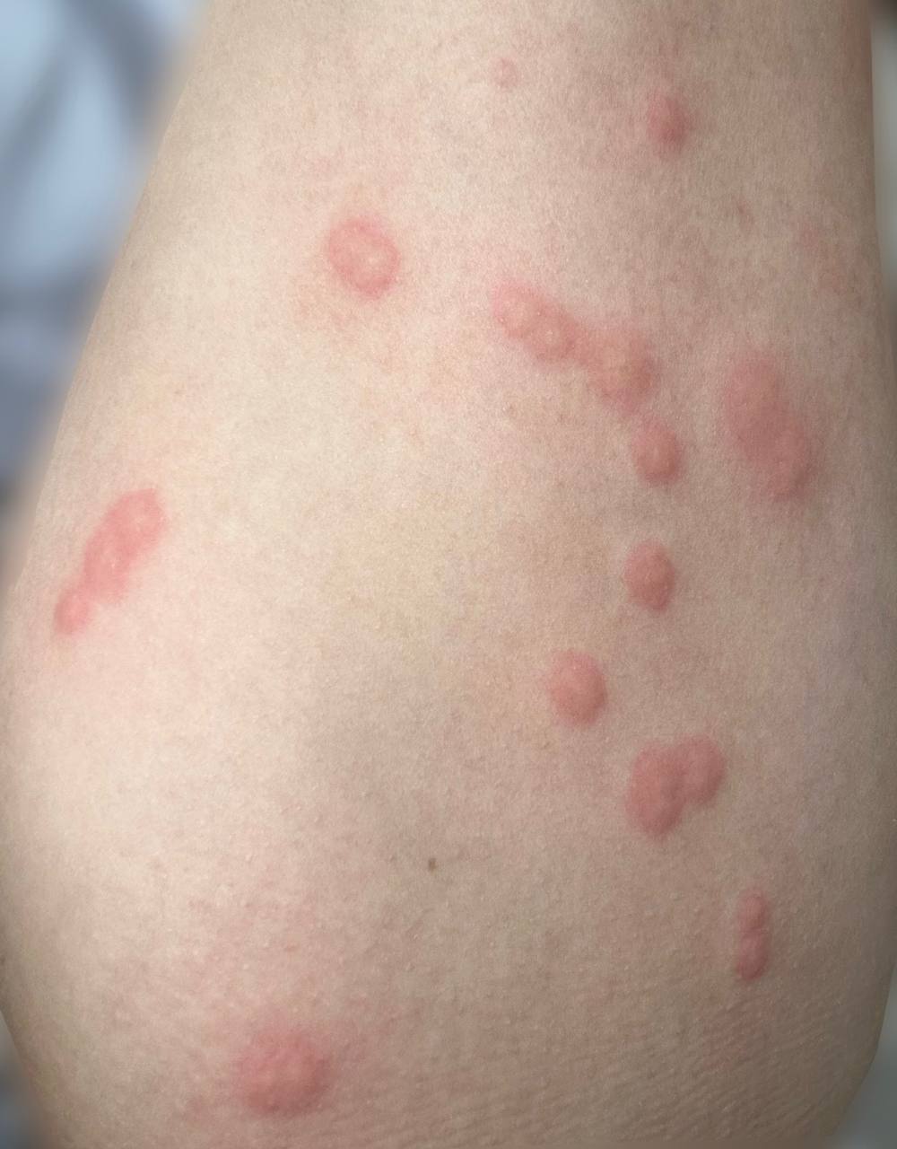 scoot insect bites 